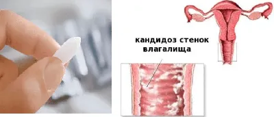 Как проявляется молочница?