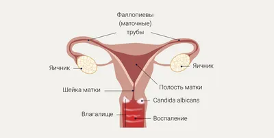 Как быстро избавиться от молочницы раз и навсегда - Как эффективно вылечить  молочницу женщин, мужчин, ребенка, при беременности