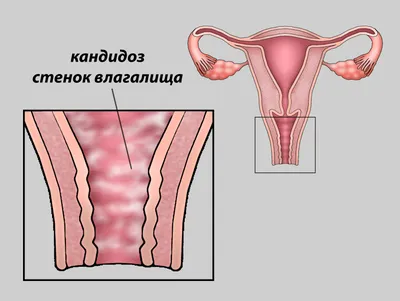 Хроническая молочница у женщин: симптомы, что делать, как и чем лечить?