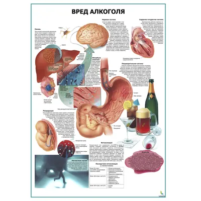Вред алкоголя - медицинский плакат | Купить медицинский образовательный  плакат о вреде алкоголя