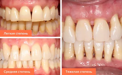 Протезирование зубов при пародонтозе и пародонтите в Минске - Новости и  статьи