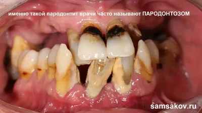 Лечение пародонтоза у метро Орехово в Москве — цены в стоматологической  клинике «Medical Star»