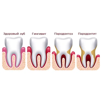 Пародонтоз – причины, симптомы, лечение в Москве – цены, отзывы в  стоматологических клиниках Зуб.ру
