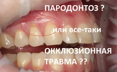 Пародонтоз десен и зубов: реабилитация после лечения - Альянс  бьюти-стоматологов, Москва