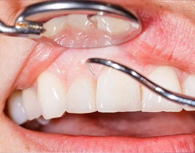 Ош стоматолог Ортодонт Брекет - Лечение пародонтоза. Объем  стоматологической помощи пациентам с пародонтозом зависит от стадии  заболевания. Пациенты не замечают начальных симптомов болезни и обращаются  к специалисту уже в запущенных случаях. В