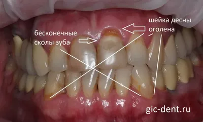 Лечение пародонтоза и парадонтита в Москве | цены на лечегие патологических  процессов в стоматологической клинике Дента Лэнд