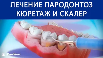 Пародонтоз. Доступная стоматология и имплантация