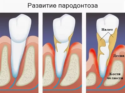 Пародонтоз: причины появления, симптомы и эффективное лечение заболевания в  стоматологической клинике