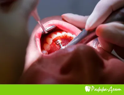 Имплантация при пародонтозе и пародонтите - лечение, восстановление зубов