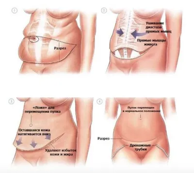 Как убрать живот после родов и подтянуть кожу: избавиться от складок,  дряблости, вернуть прежний вид
