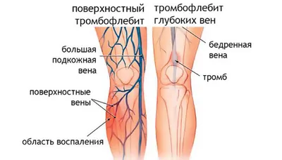 Тромбофлебит нижних конечностей - Центр сосудистой хирургии и флебологии  \"Viamedis\". Флеболог Астана