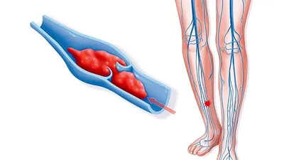 Тромбофлебит: симптомы, причины, классификация, осложнения, что делать,  профилактика