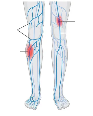 Тромбоз и тромбофлебит вен нижних конечностей: лечение и диагностика в  Одессе | Медицинский дом Odrex