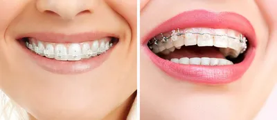Здоровые зубы: 5 золотых правил- Ирригаторы DEMIAND