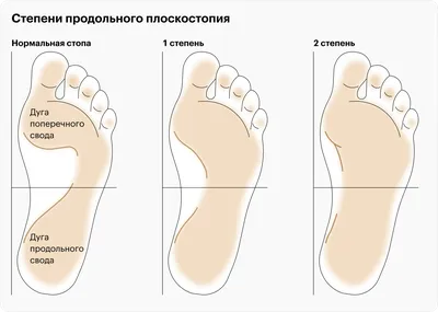 Гимнастики и ЛФК при плоскостопии, и профилактика плоскостопия! — 54  ответов | форум Babyblog