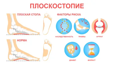 10 привычек для профилактики плоскостопия. Спорт-Экспресс