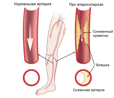 Дерматология - Со слов пациентки, каждую неделю очищает стопу  самостоятельно пемзой, и каждую неделю на одной ноге эта картина появляется  вновь. Плюс ноготь большого пальца этой же ноги с микозом. Ваши версии? #