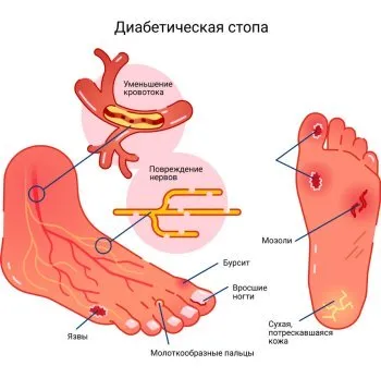 Микоз кожи стоп, ногтей, головы, рук | Лечение микоза у ребенка и взрослого  в Клинике подологии Полёт в Москве