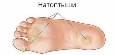 Ноги атопического дерматита крупного плана раздражения кожи Newborn  царапают Стоковое Изображение - изображение насчитывающей внимательность,  иносказательных: 99245145