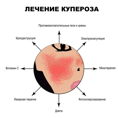 Как избавиться от купероза на лице: эффективные процедуры - Центры эпиляции  и косметологии