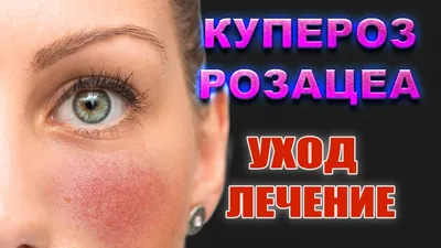 Удаление купероза на лице аппаратом М22 | Premium Aesthetics