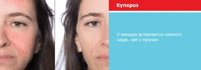 Купероз: причины появления и способы борьбы с проблемой | Glamour