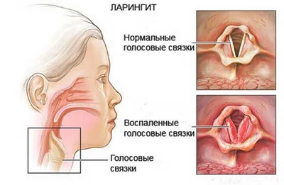 Ларингит в картинках