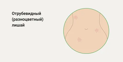 Розовый лишай - Дерматологическая патология - Справочник MSD  Профессиональная версия