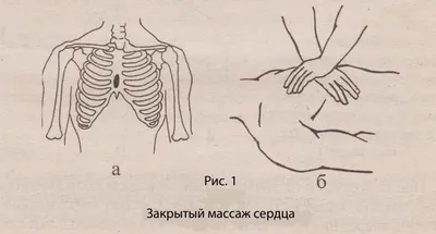 Закрытый массаж сердца и искусственное дыхание