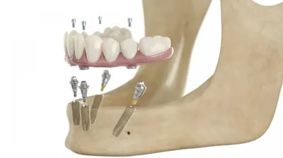 Мост на зубы: цена в Москве | Установка несъемного протеза в клинике Доктор  Бон