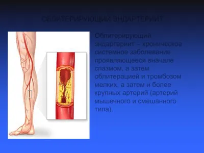 Облитерирующий атеросклероз сосудов нижних конечностей: лечение - Akhmad  Vascular