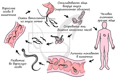 Как Избавиться от Глистов(Остриц), Быстро и Эфективно в Домашних  условиях... | Доктор Жирафик | Дзен