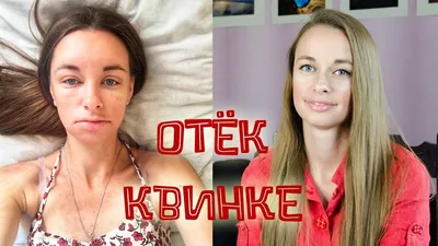 КРИК ДУШИ КРАПИВНИЦА И ОТЁК КВИНКЕ | Пикабу