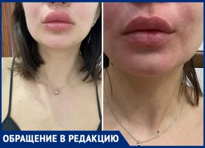 Центр слуха и речи Мединкус в Оше - Первая помощь при отёке Квинке. Первые  ощущения, которые испытывает человек, - это жжение и небольшое покалывание  в месте локализации будущей отёчности. Затем возникает отёк.