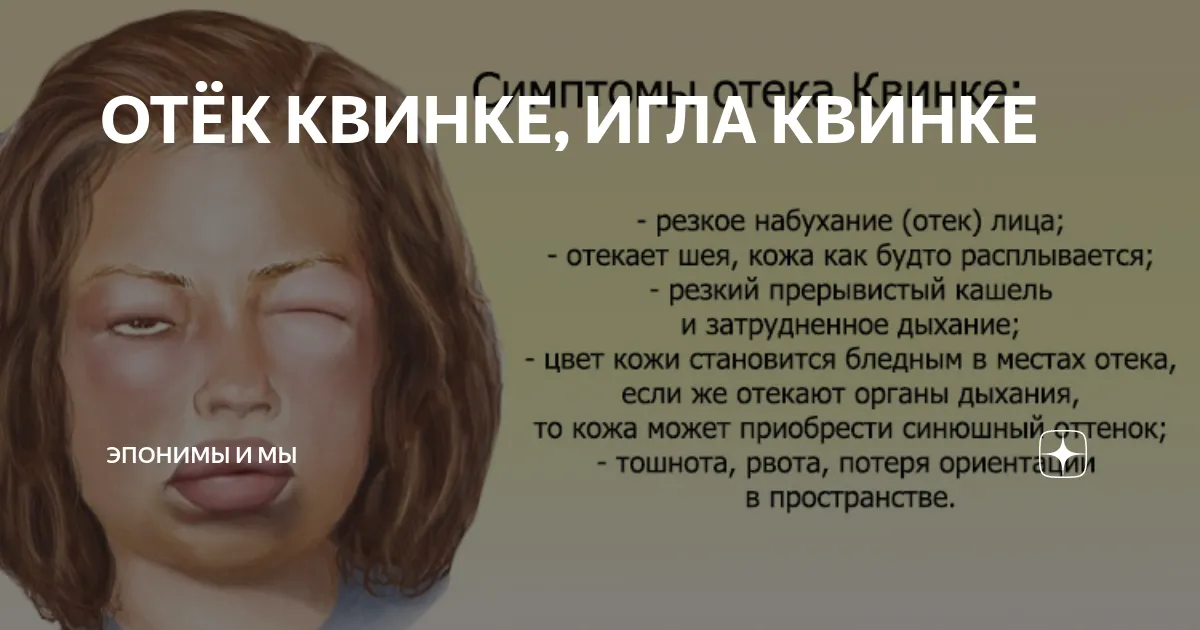 Отек квинке действия