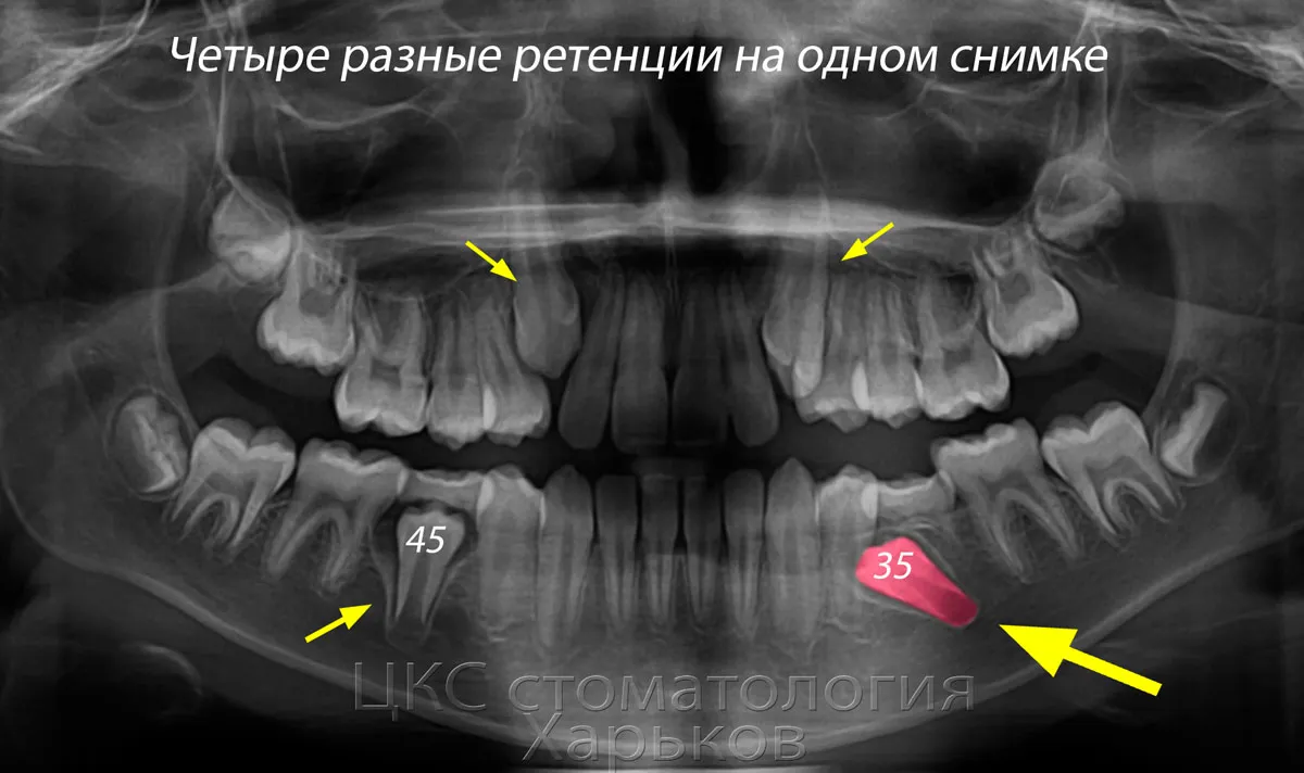 Фото Ретинированных Зубов Мудрости