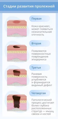 Учреждение здравоохранения \"Щучинская центральная районная больница\" -  Профилактика пролежней и уход за пациентами