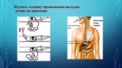 Промывание желудка с желудочной трубкой Векторное изображение ©Artemida-psy  308084950