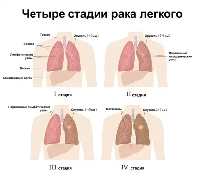 Опухоль средостения | Пикабу