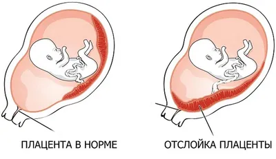 Головное предлежание плода - причины, симптомы, диагностика и лечение в  клинике «Будь Здоров»