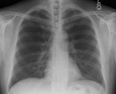 Рентгенография грудной клетки — Википедия