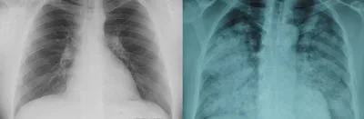 Обычный Рентген Грудной Клетки Нормальные Здоровые Легкие — стоковые  фотографии и другие картинки Анатомия - iStock