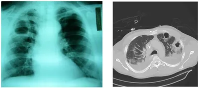 Как выглядит пневмония на рентгене, описание пневмонии на рентген снимке,  рентгеновские признаки пневмонии