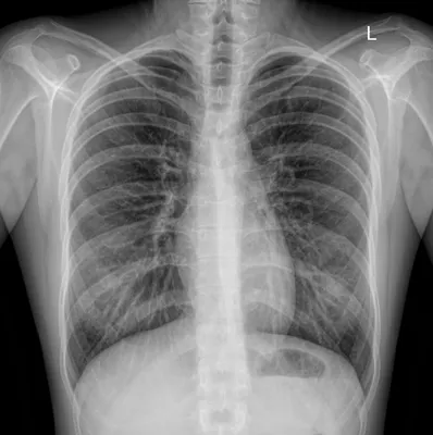 Рентген легких - цена, сделать рентгенографию легких в «СМ-Клиника»