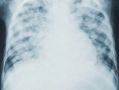 УЗИ легких лучше, чем рентген грудной клетки, для диагностики COVID-19