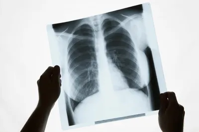 Рентген фотографии здоровых легких и сердца Стоковое Изображение -  изображение насчитывающей этничность, здоровье: 212135371