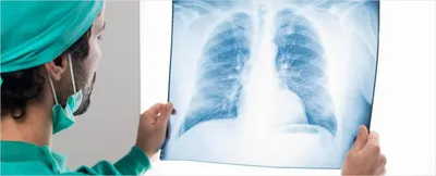 Рентген грудной клетки у детей. Очаговая пневмония. - YouTube