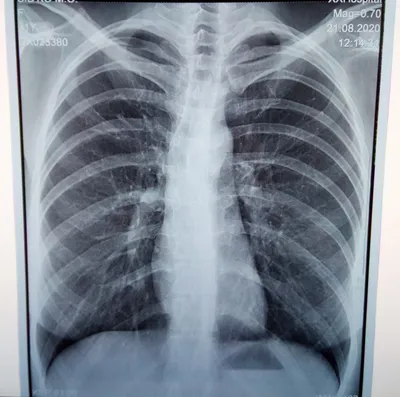 Рентген легких показывает через изображение легких врач делает анализ  рентгеновских лучей из легких человека. Стоковое Изображение - изображение  насчитывающей изображение, черный: 201322701