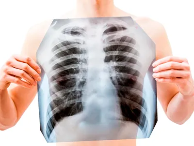 Dr. Voronina Valeria - ⁉️ Почему нужно делать КТ легких, а не рентген?  🔺То, что мы видим на рентгенограмме - без видимых и очаговых инфильтраций,  можно интерпретировать как норма, и то что