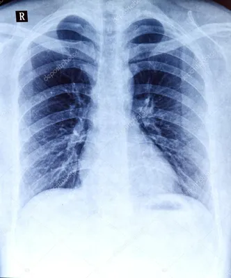 Рентгенография легких - Инновационный сосудистый центр - ИСЦ